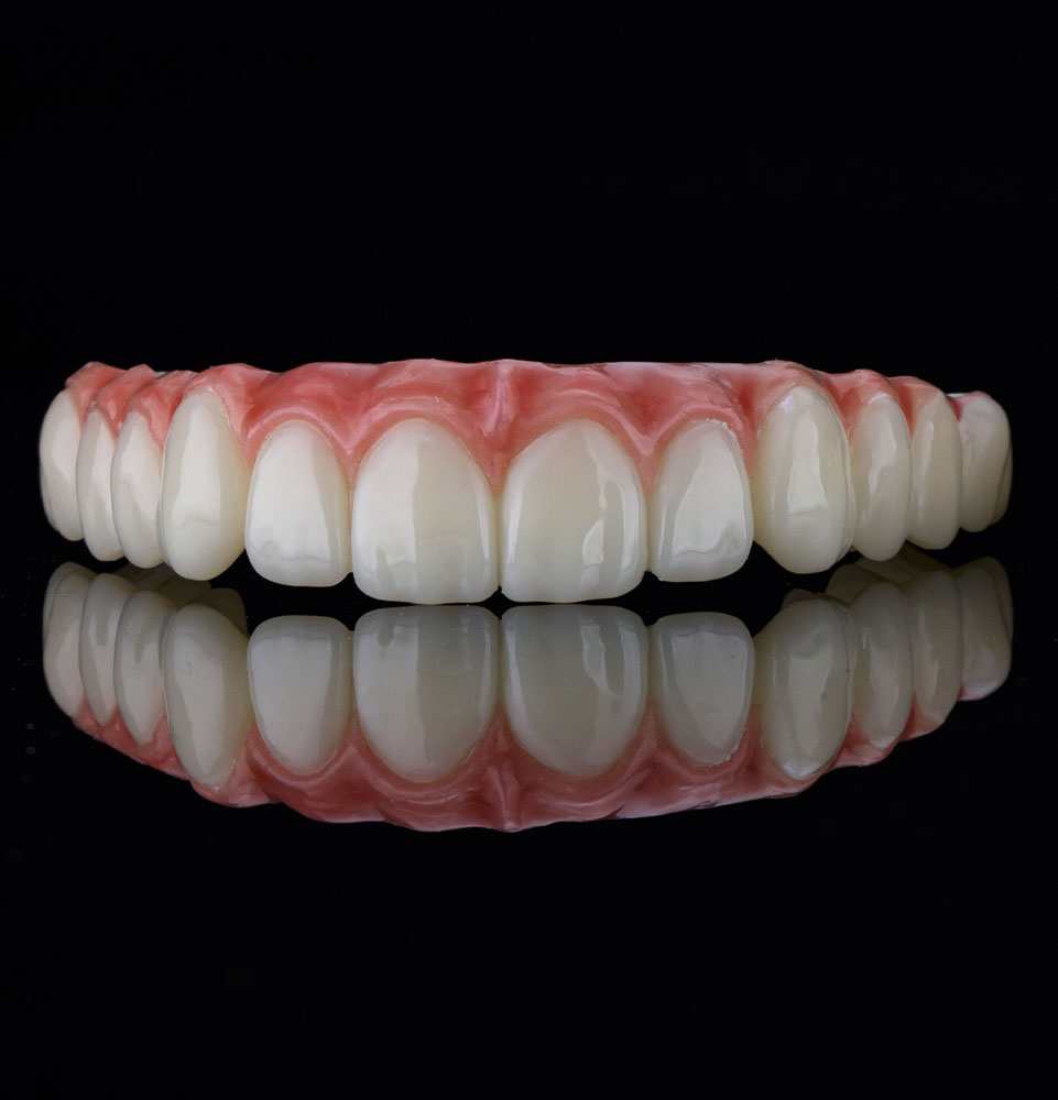 full arch dental implant real