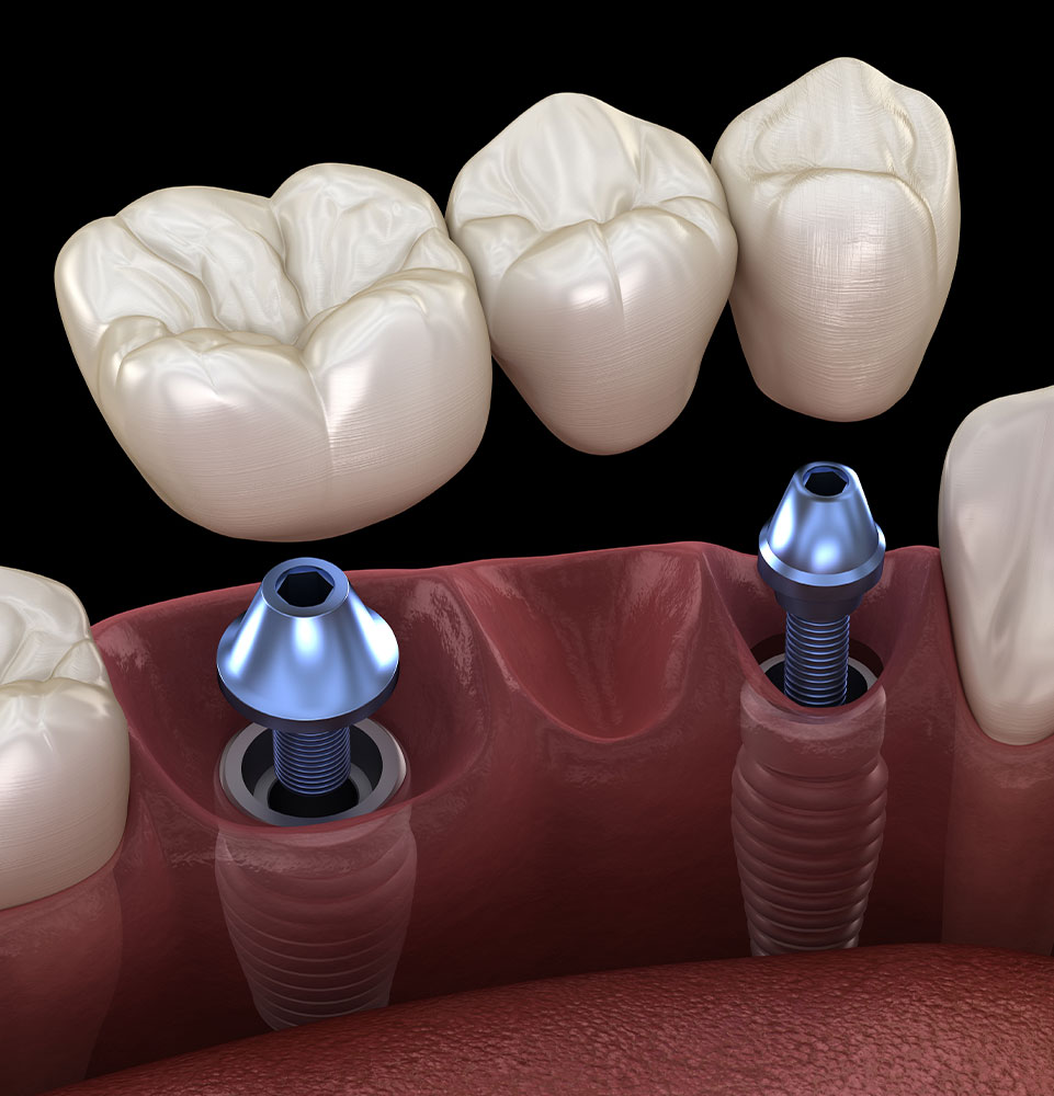 dental implant bridge 3d